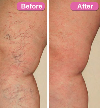 Vein Treatment Before and After