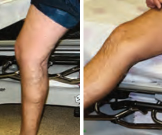 Vein Before and After